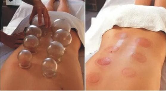 Hijama Therapy